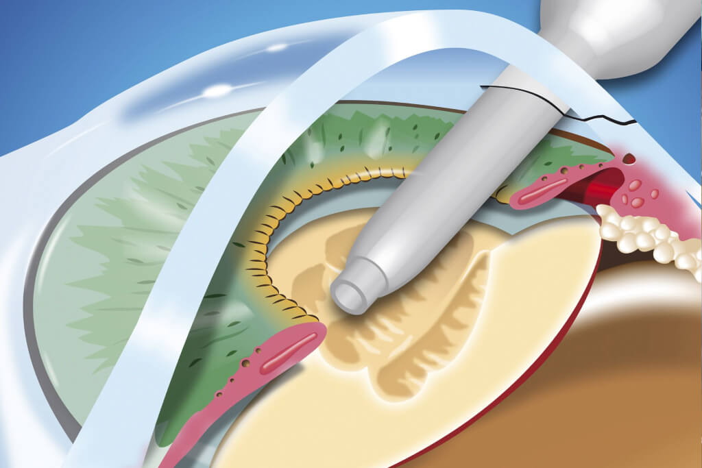 Cataract Phaco Surgery Lens Options