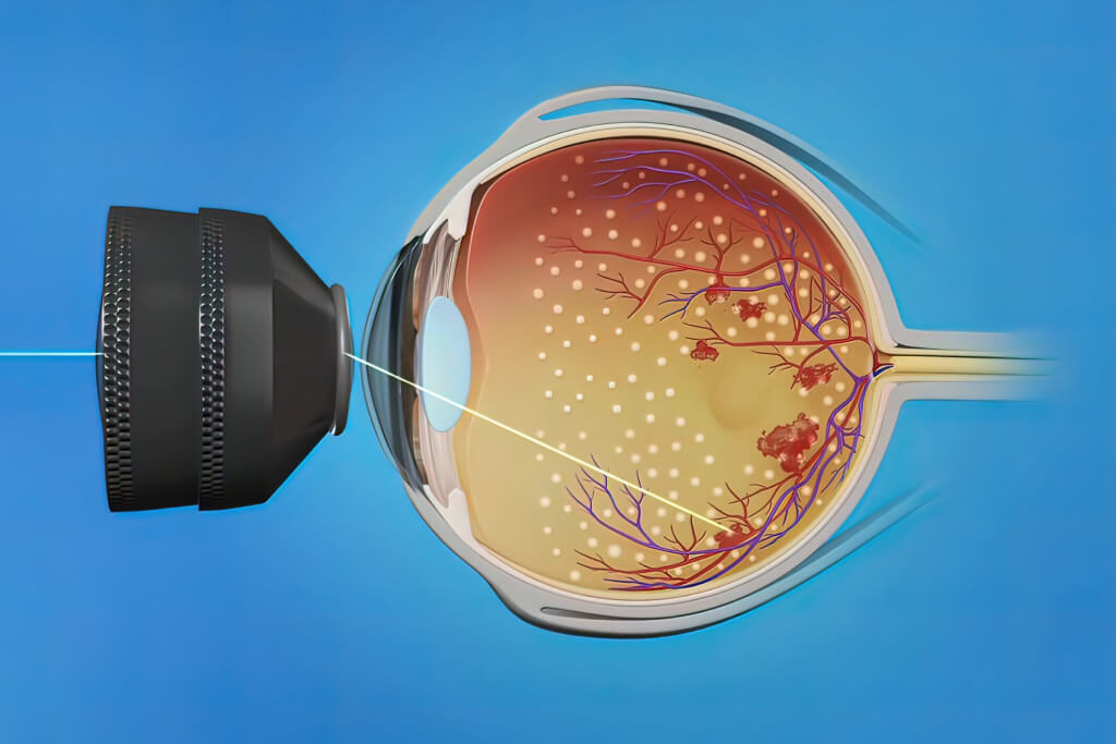 Laser for Diabetic Retinopathy