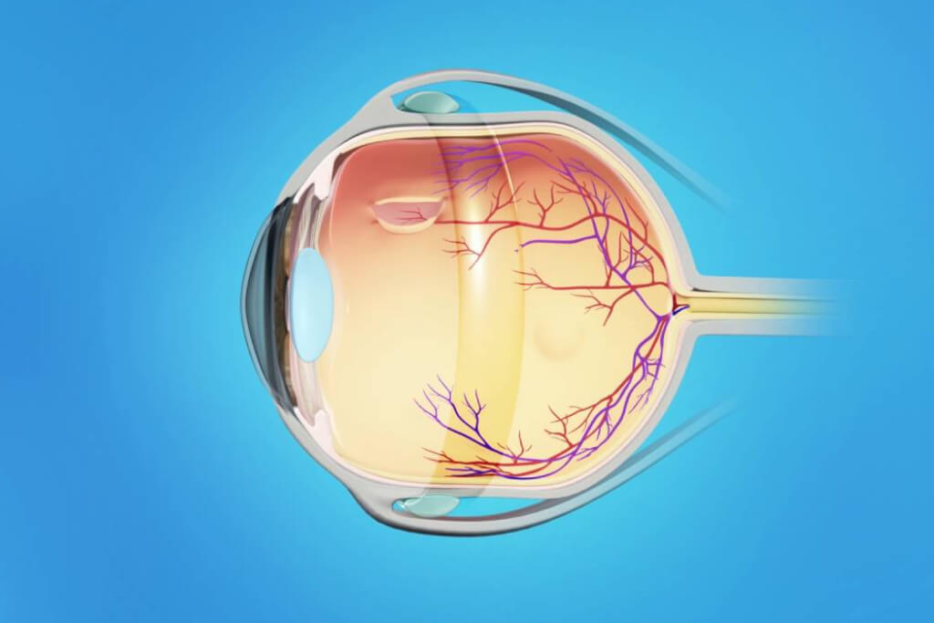 Scleral Buckling Surgery for Retinal Detachment