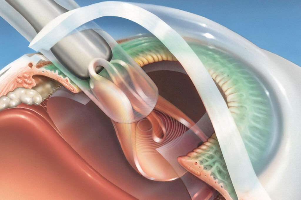 Cataract Phaco Surgery with TORIC Lens